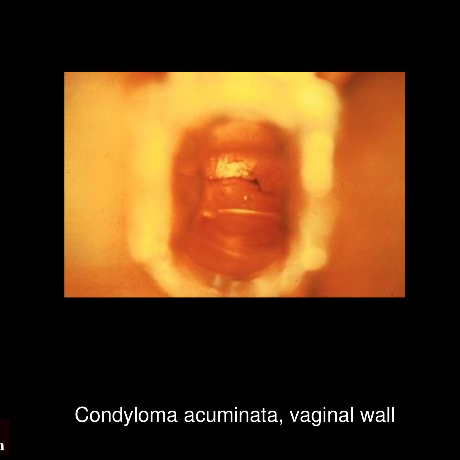 Extensive condyloma acuminata involving penile shaft and glans showing large confluent cauliflower-like warts requiring surgical treatment